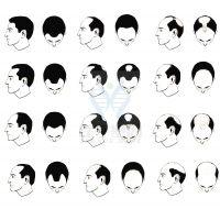 【EVO视讯官网基因检测】过早<font color='red'>脱发</font>、掉发太多怎么办？你的方法可能是错的！